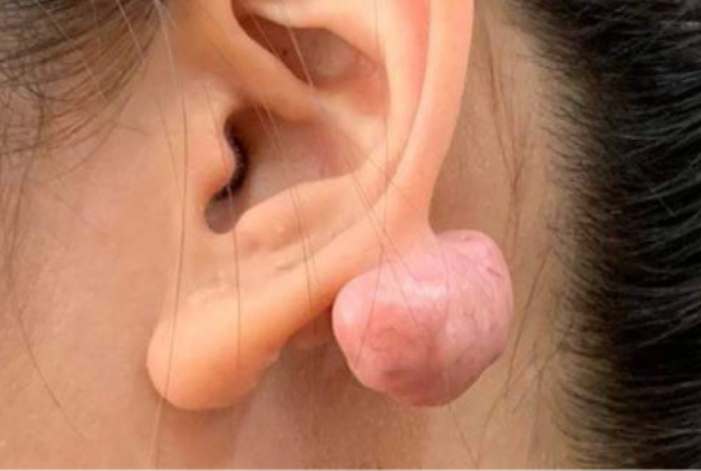 What is keloid disease?