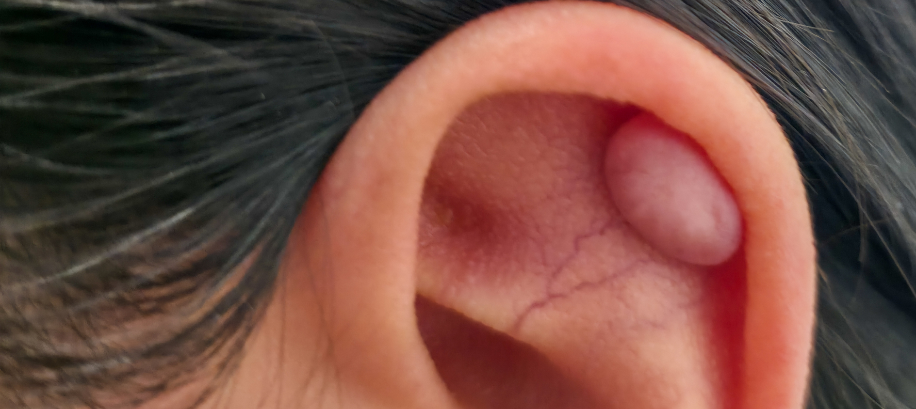 Keloids treatment options for patients