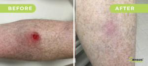 Basal cell carcinoma, before and after Superficial Radiotherapy (SRT) treatment